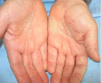 Da Bị Dị Ứng Với Dầu Cắt Gọt Kim Loại Pha Nước